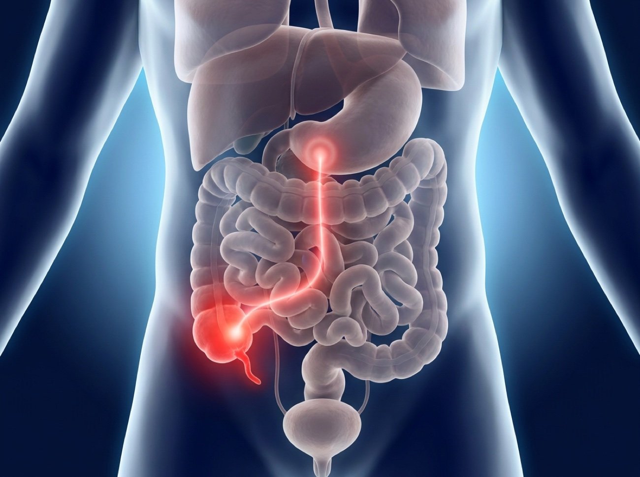 Ilustración 3D del dolor de la apendicitis: inicia en la parte alta del abdomen y se desplaza al apéndice inflamado en el lado inferior derecho