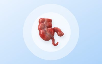 Apendicitis aguda: Qué es?, cómo detectarla a tiempo y cómo se trata 