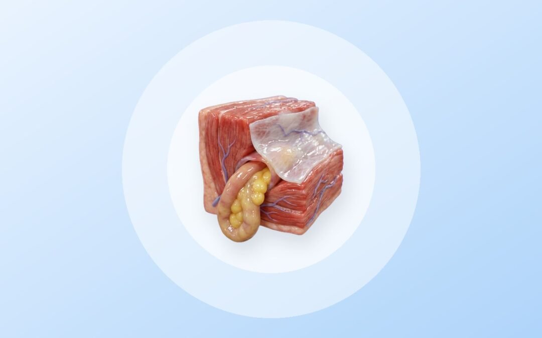 Ilustración 3D: hernia inguinal