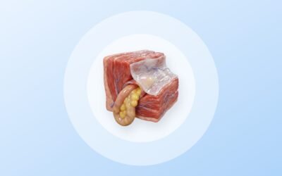 Hernia inguinal: síntomas, causas y cuándo operar