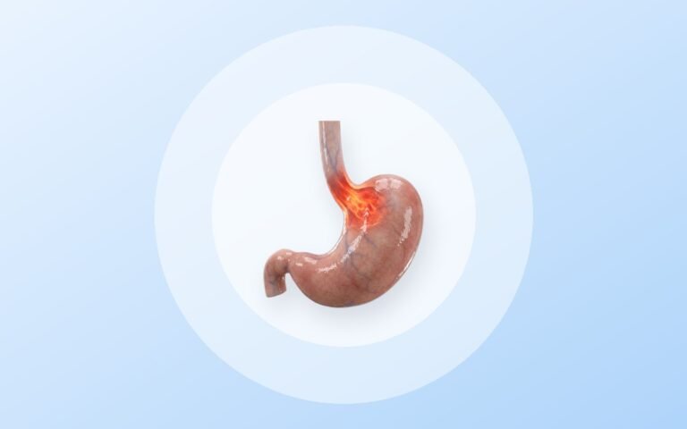 Reflujo gastroesofágico: cuándo pensar en cirugía